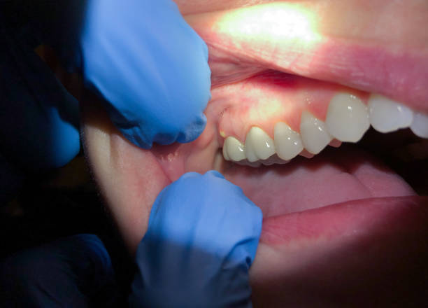 Best Emergency Dentist for Lost Fillings or Crowns in Sunnyside Tahoe City, CA